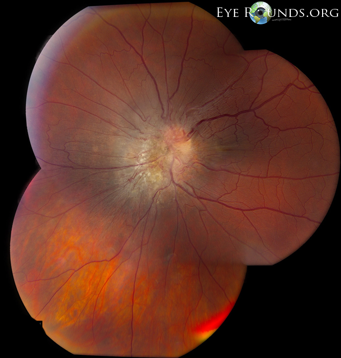 The retina and retinal pigment epithelium (RPE)