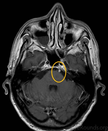 cranial schwannoma nerve palsy abducens mri cn atlas sixth eyerounds enhancement pons ophthalmic secondary left mononeuropathy licensed noncommercial attribution noderivs