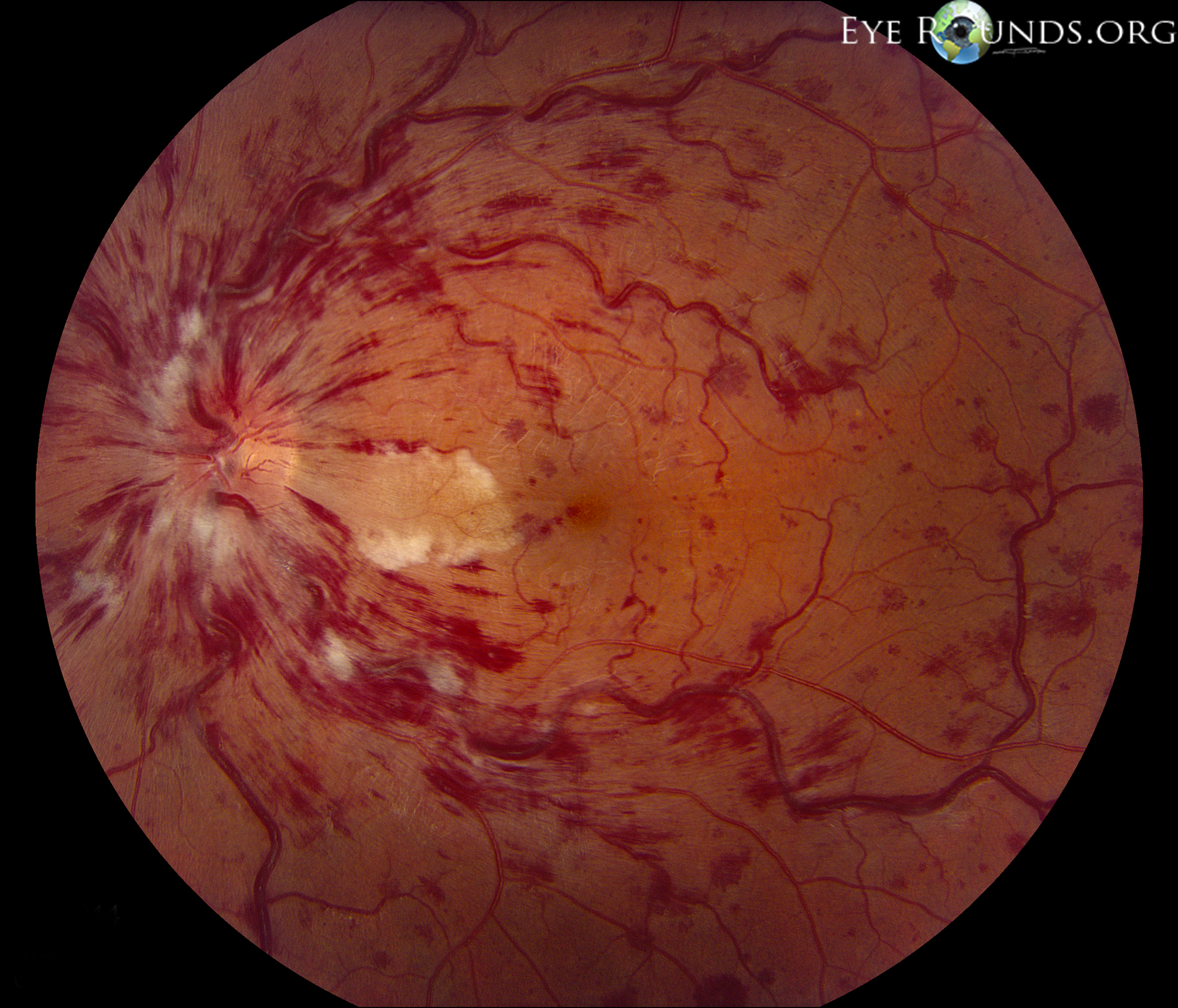fundus with Cilioretinal artery occlusion (CLRAO) 