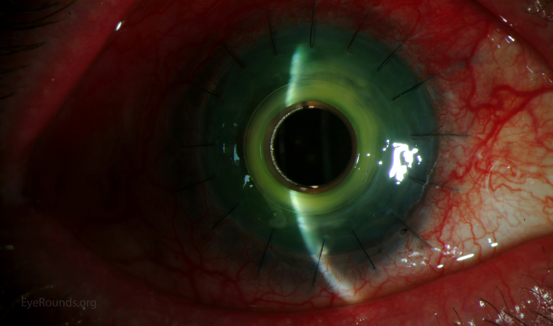 KPro Infected - Slit Lamp View