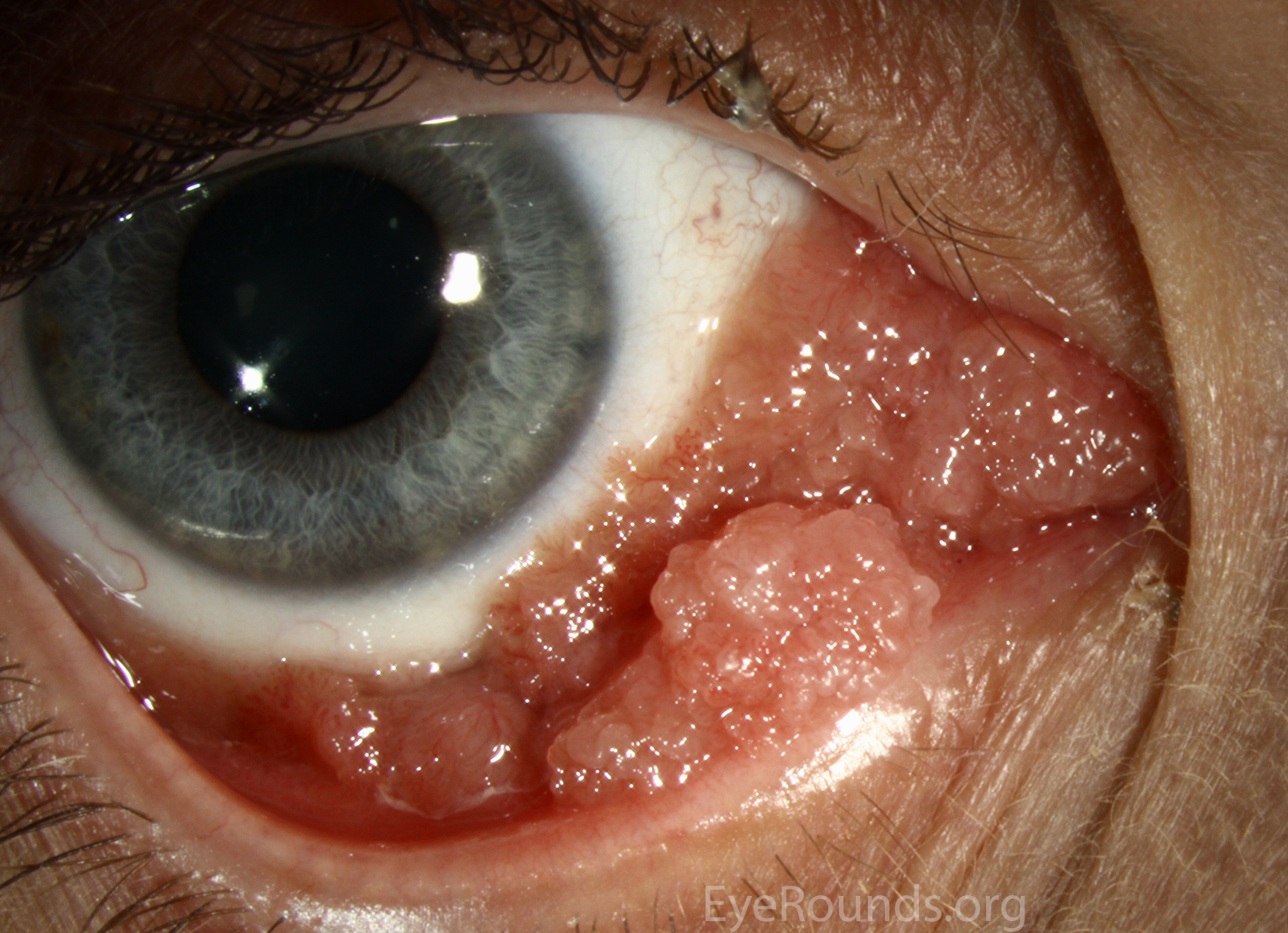 Conjunctival papilloma