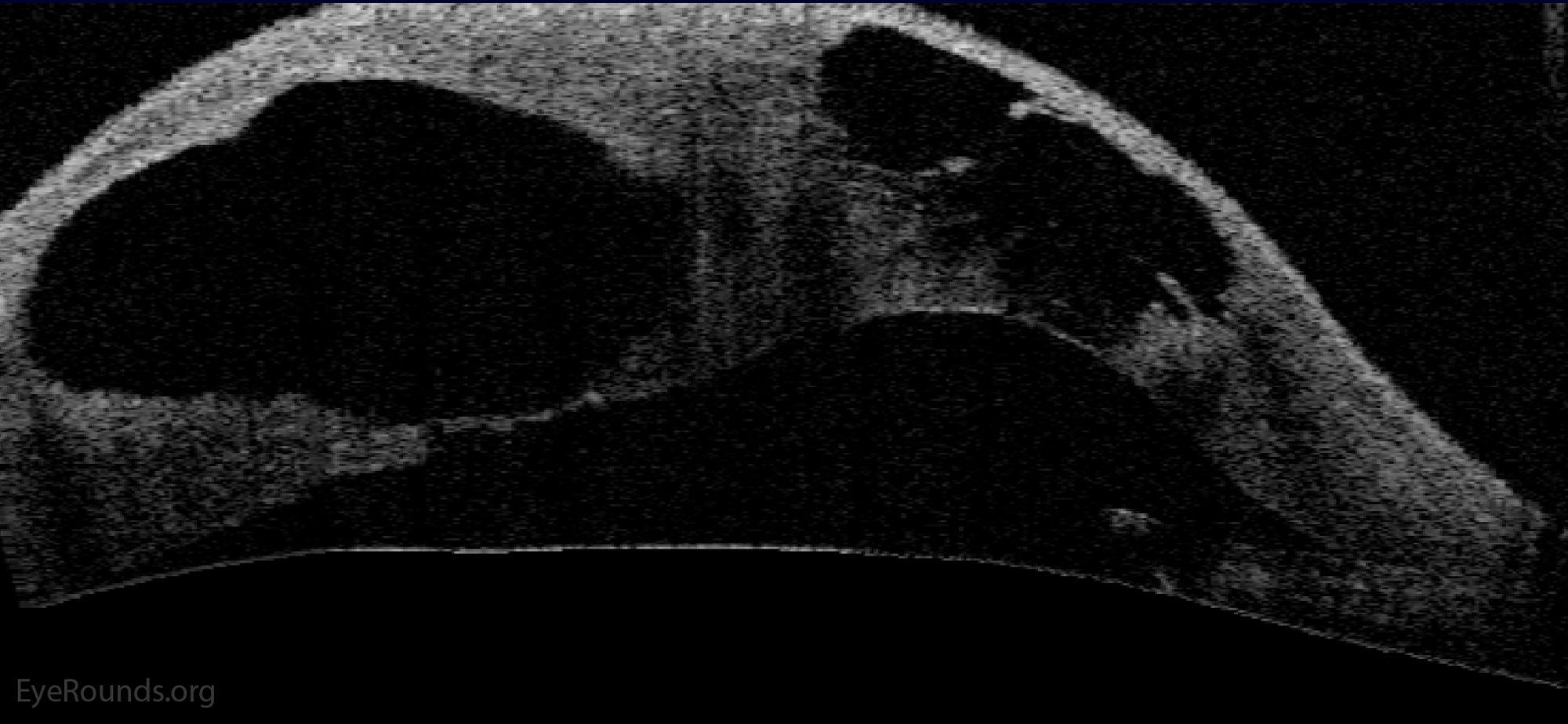 OCT showing stromal edema