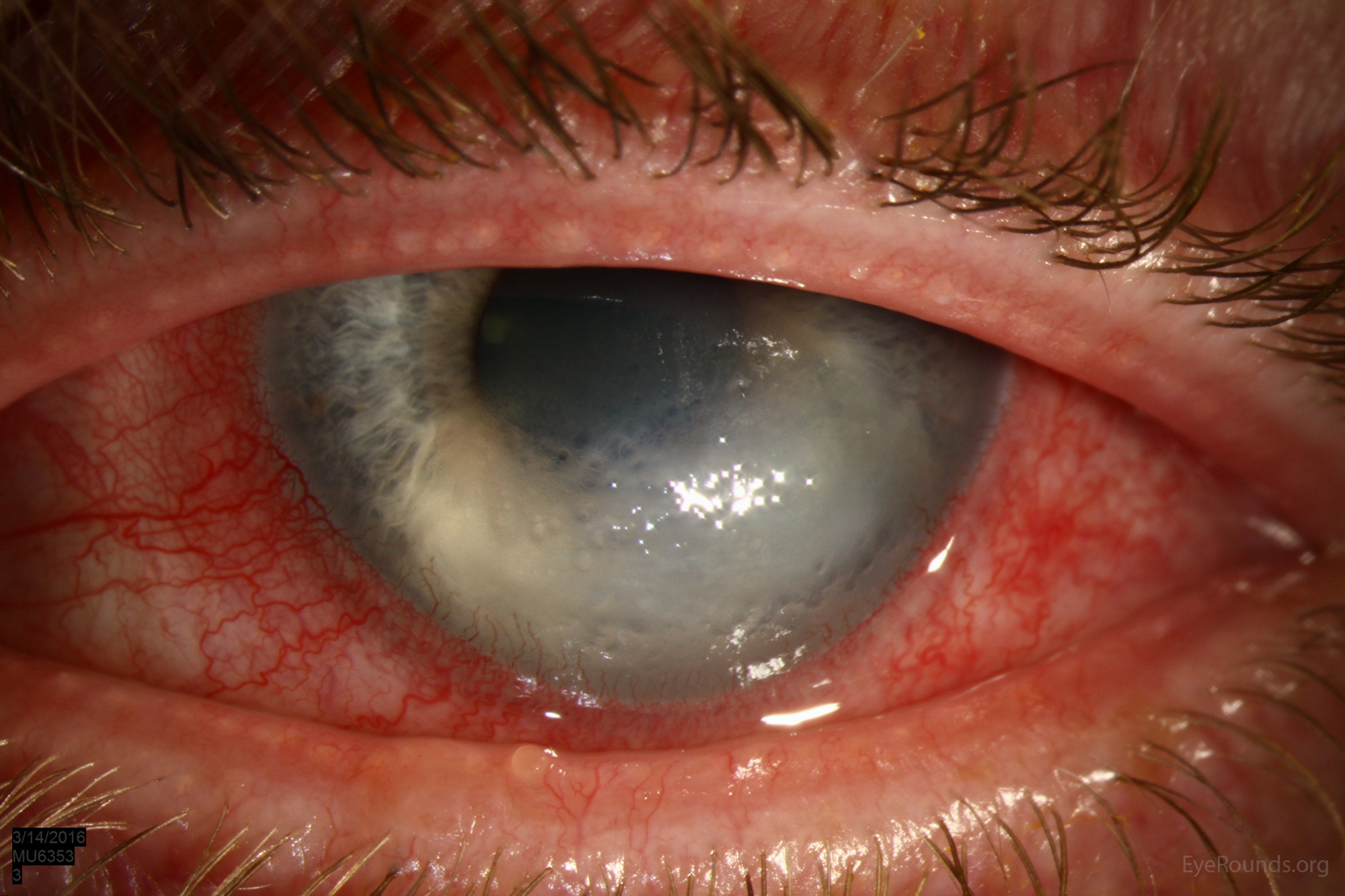 acute hydrops, sever inferior corneal stromal edema