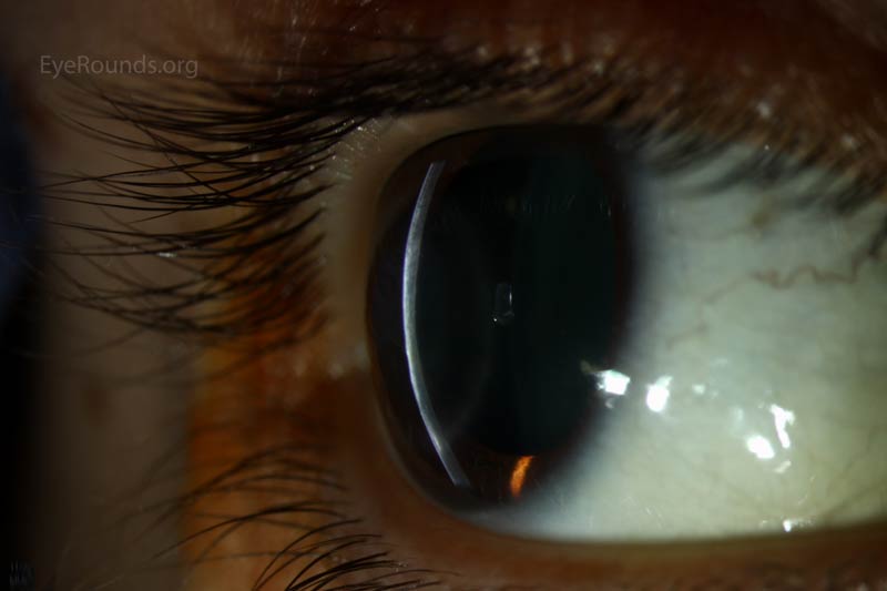 Herpes simplex virus (HSV) disciform keratitis