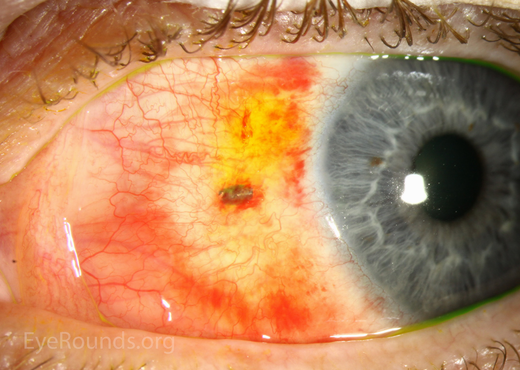 Atlas Entry Subconjunctival Metallic Foreign Body