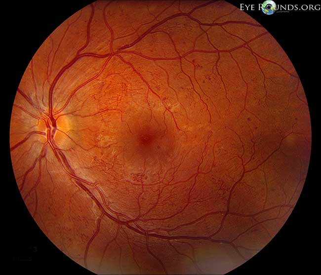 diabetic patient with severe non-proliferative diabetic retinopathy