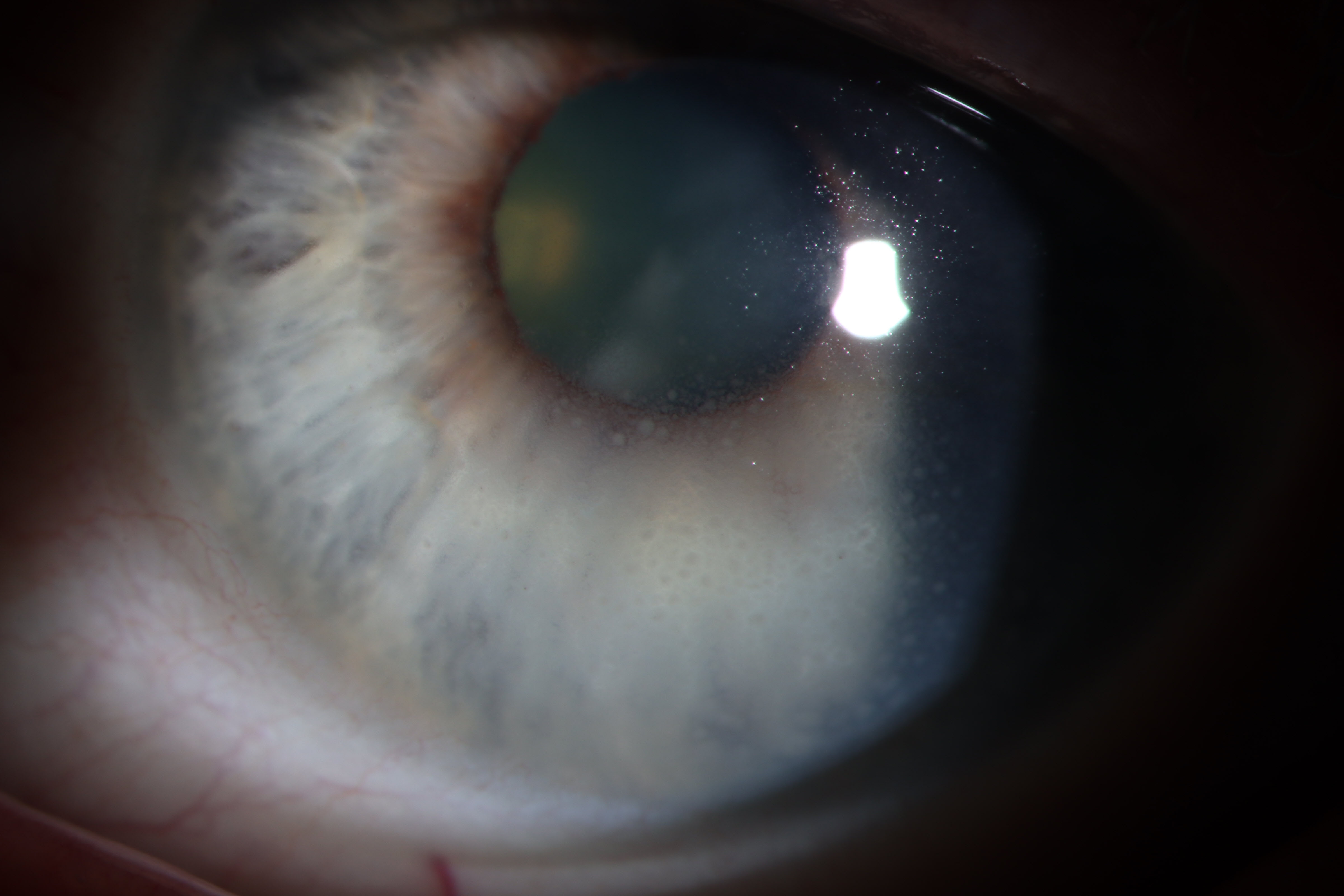 mutton fat KP slit lamp