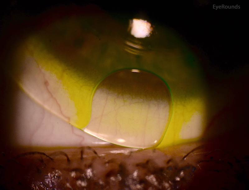 A true excessively flat soft contact lens (or soft contact lens skirt as is the case in this hybrid lens) may have too much material to rest all of its surface touching the conjunctiva. The extra or excess material can ”flute” up causing a wrinkle at the edge of the lens and/or a bubble. Such a lens is generally uncomfortable because it moves excessively with the blink and because the eyelids hit that elevated material as they traverse the surface of the eye.