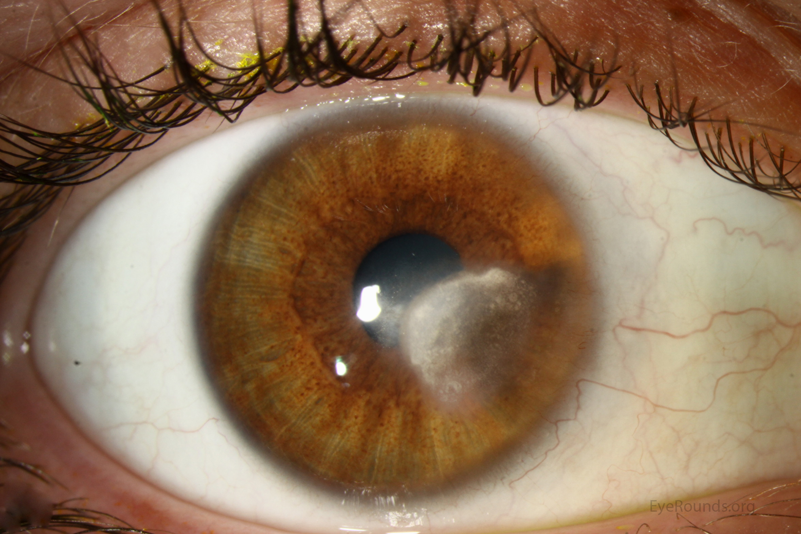 Lipid Keratopathy Dog Treatment Lipid Keratopathy Dog Treatment