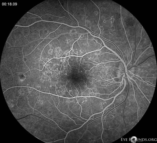 multiple-evanescent-white-dot-syndrome-mewds