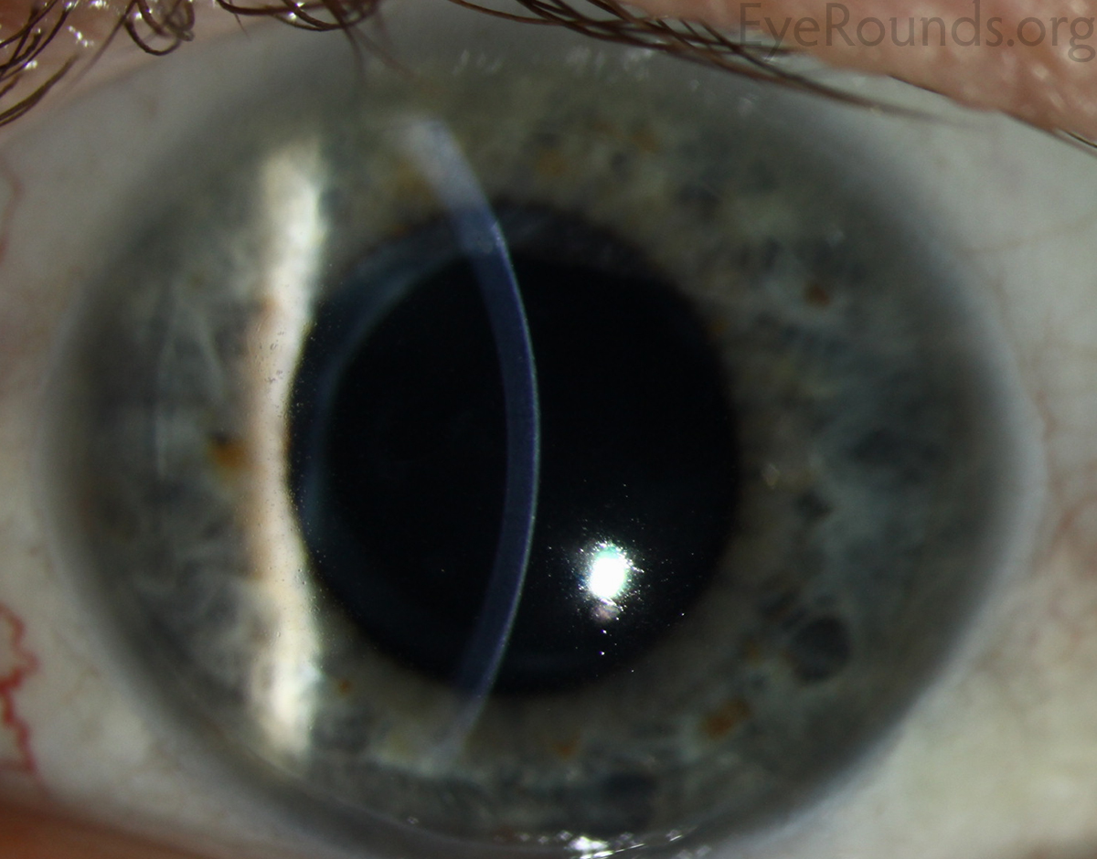 Meesmann epithelial corneal dystrophy slit lamp