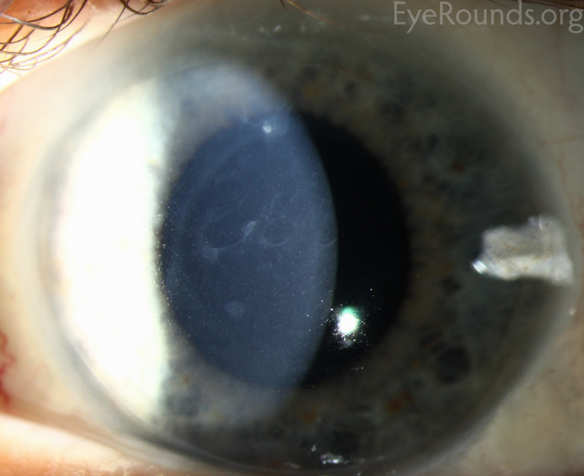 Meesmann epithelial corneal dystrophy high mag alternative 2
