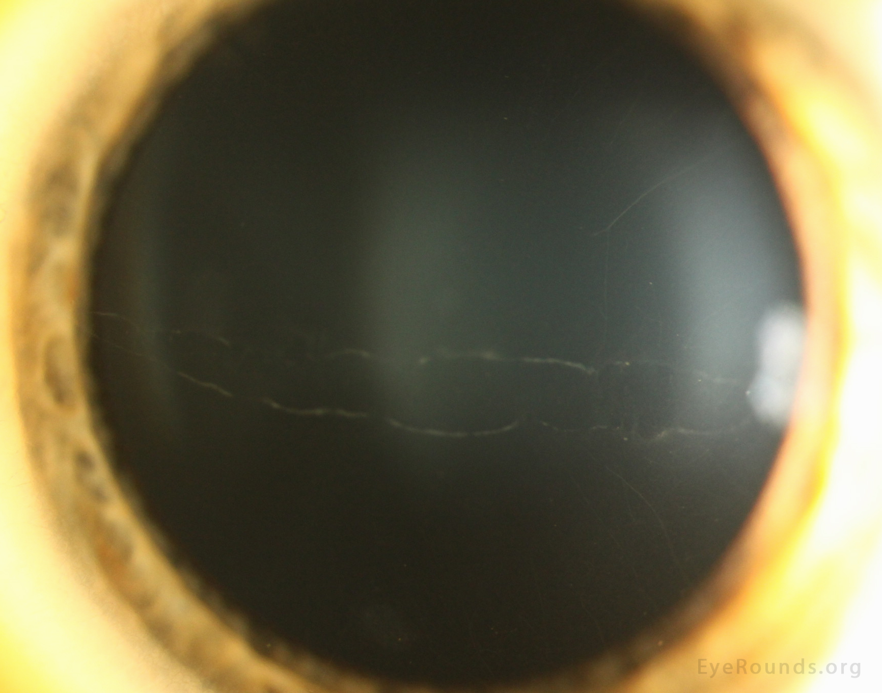 patient 2a Band lesions, sometimes called 'snail tracks,' are classically horizontal lesions with parallel, scalloped, non-tapering edges at the level of the posterior cornea