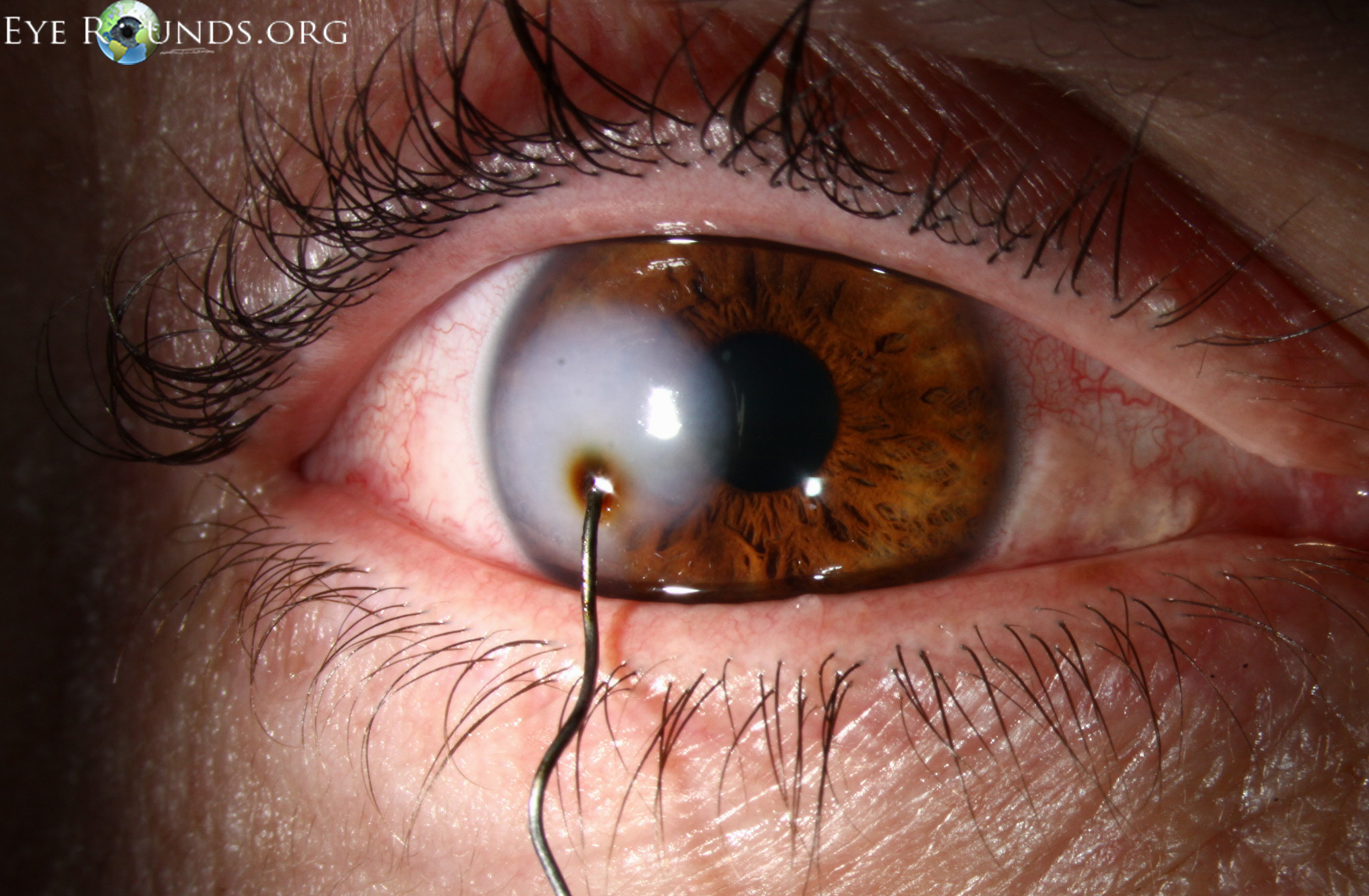 metal foreign object penetrating cornea