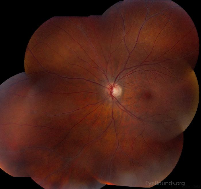 Retinal Periphlebitis