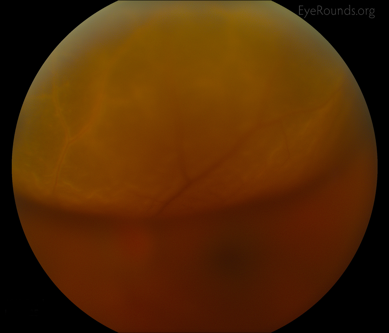 Retinal detachment with chronic intraocular foreign body - fundus