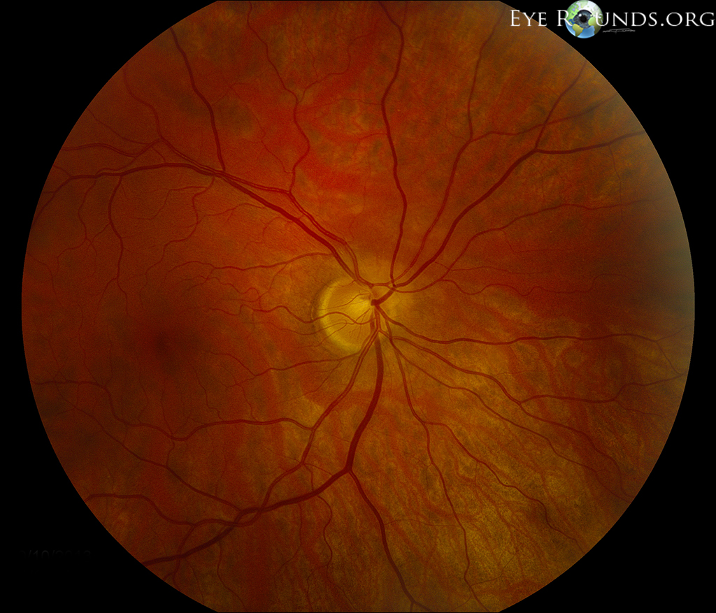 Superior segmental optic nerve hypoplasia (SSONH) fundus 