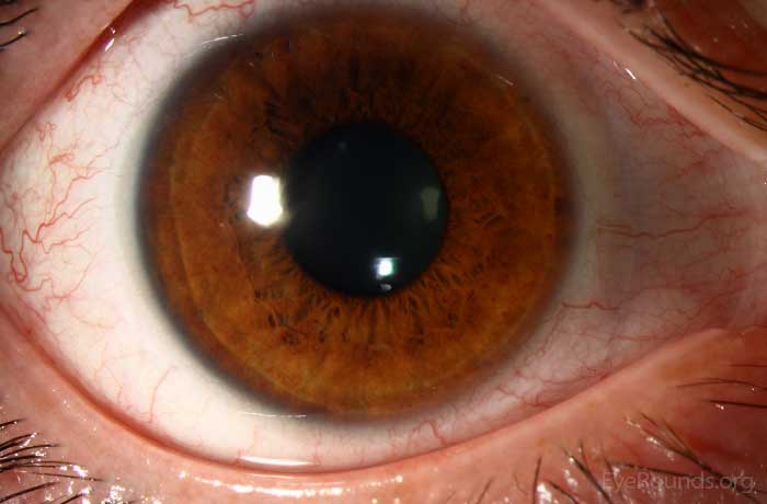 soft contact lens seated on eye