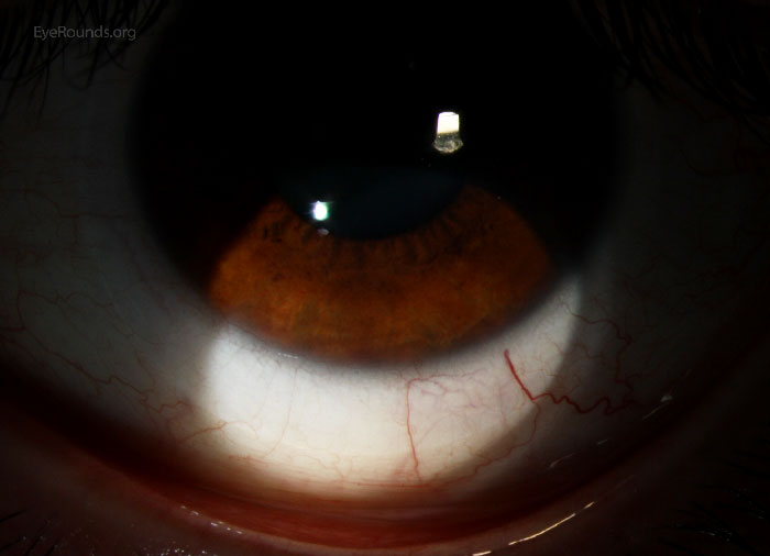 soft contact lens seated on eye, broad beam