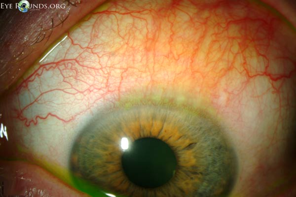 Superior limbic keratoconjunctivitis (SLK)