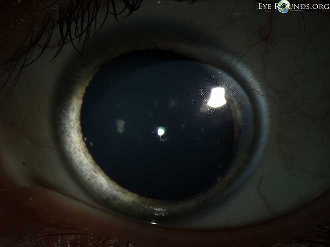  multiple slightly elevated corneal lesions which are round to oval conglomerates of gray, granular "crumblike" subepithelial opacities