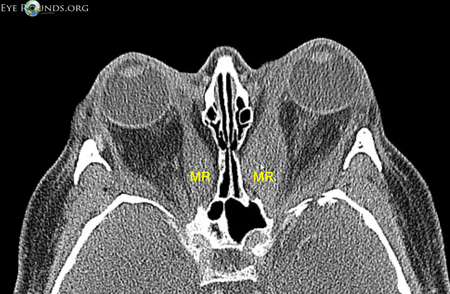 Axial CT scan showing enlarged muscle belly in Thyroid Eye Disease