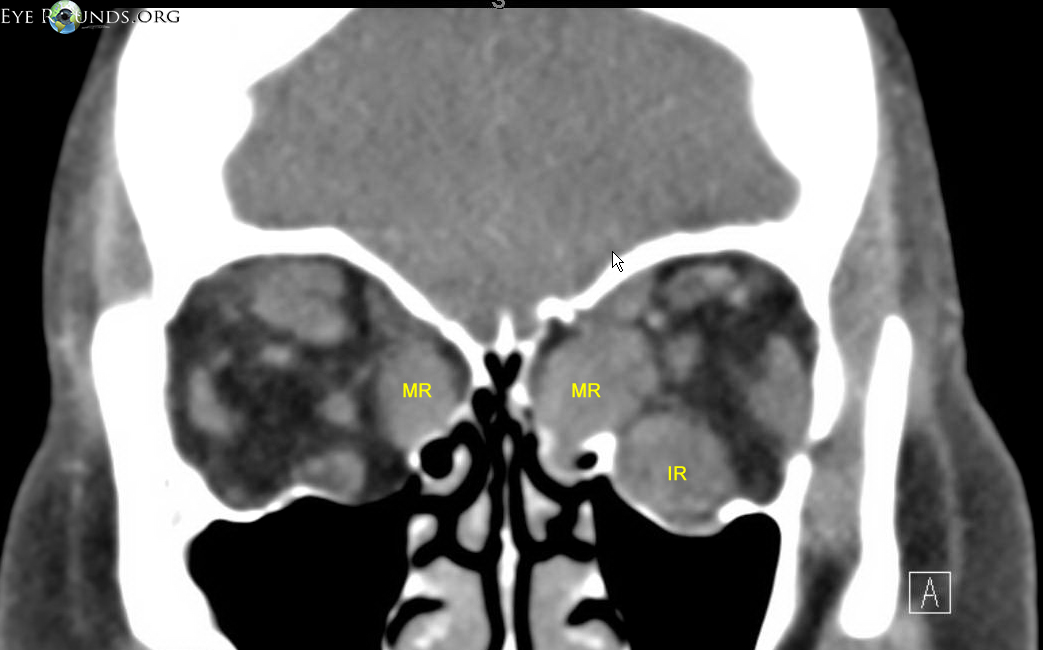 Coronal CT scan showing the enlarged muscle bellies in cross section