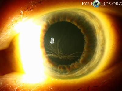 left eye, Amiodarone vortex keratopathy