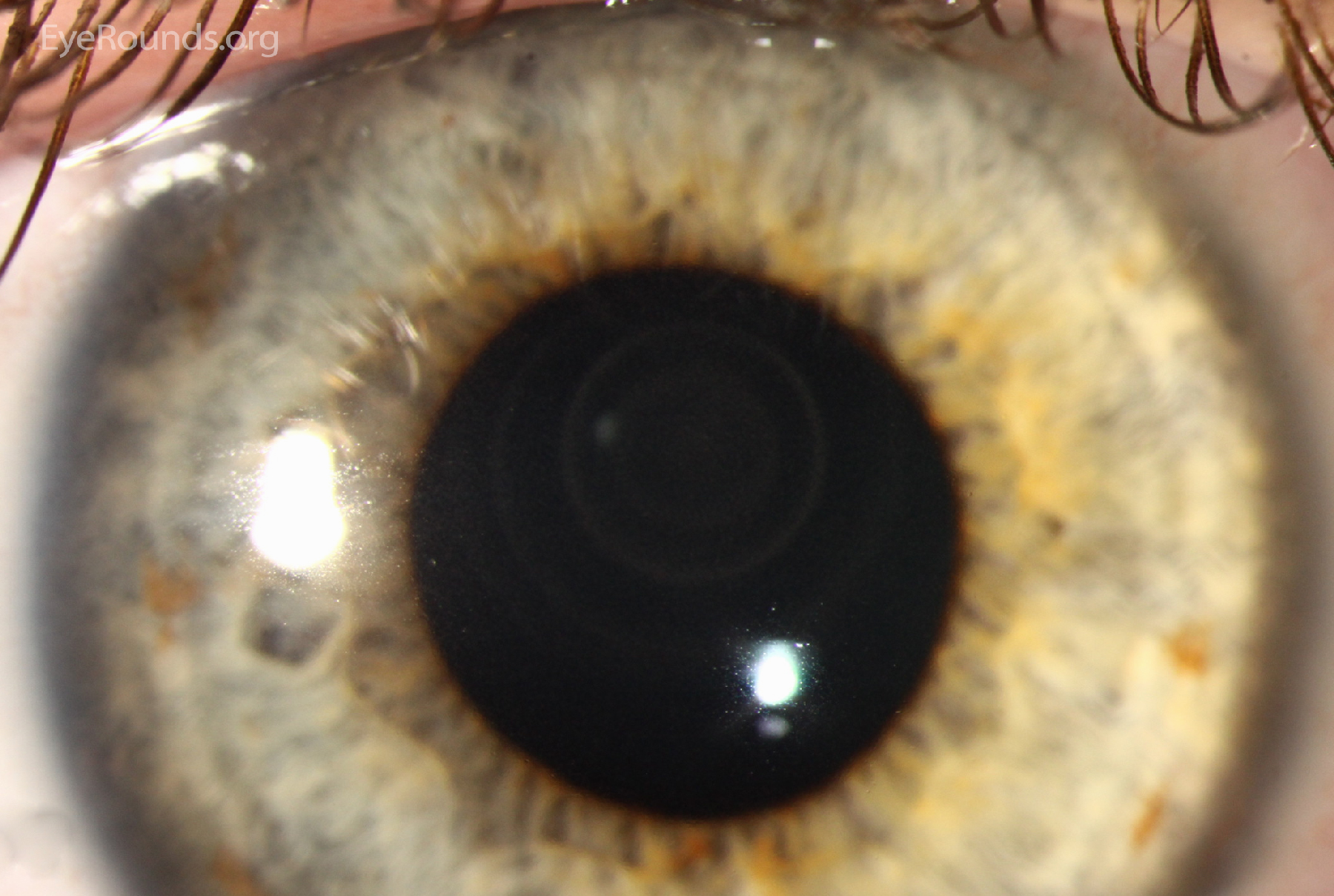 Concentric ring infiltrate in a contact lens wearer with early Acanthamoeba keratitis