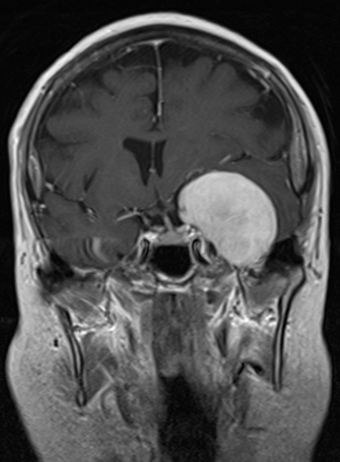 MRI - Cavernous Sinus Syndrome
