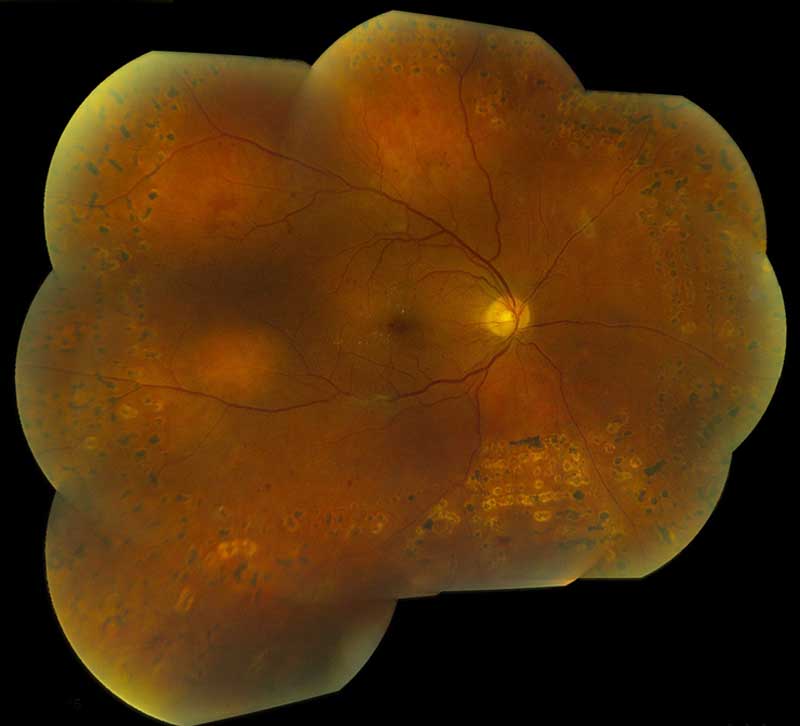 Circumscribed choroidal hemangioma