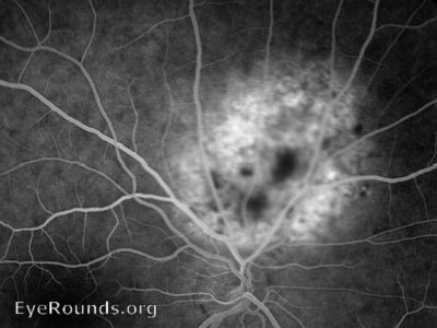 early phases of flourescein angiograph with hyperflourescence within the lesion
