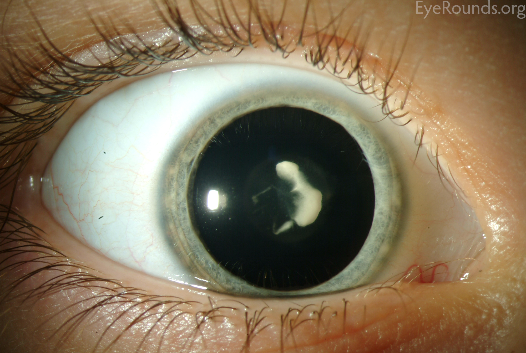 congential nuclear cataract