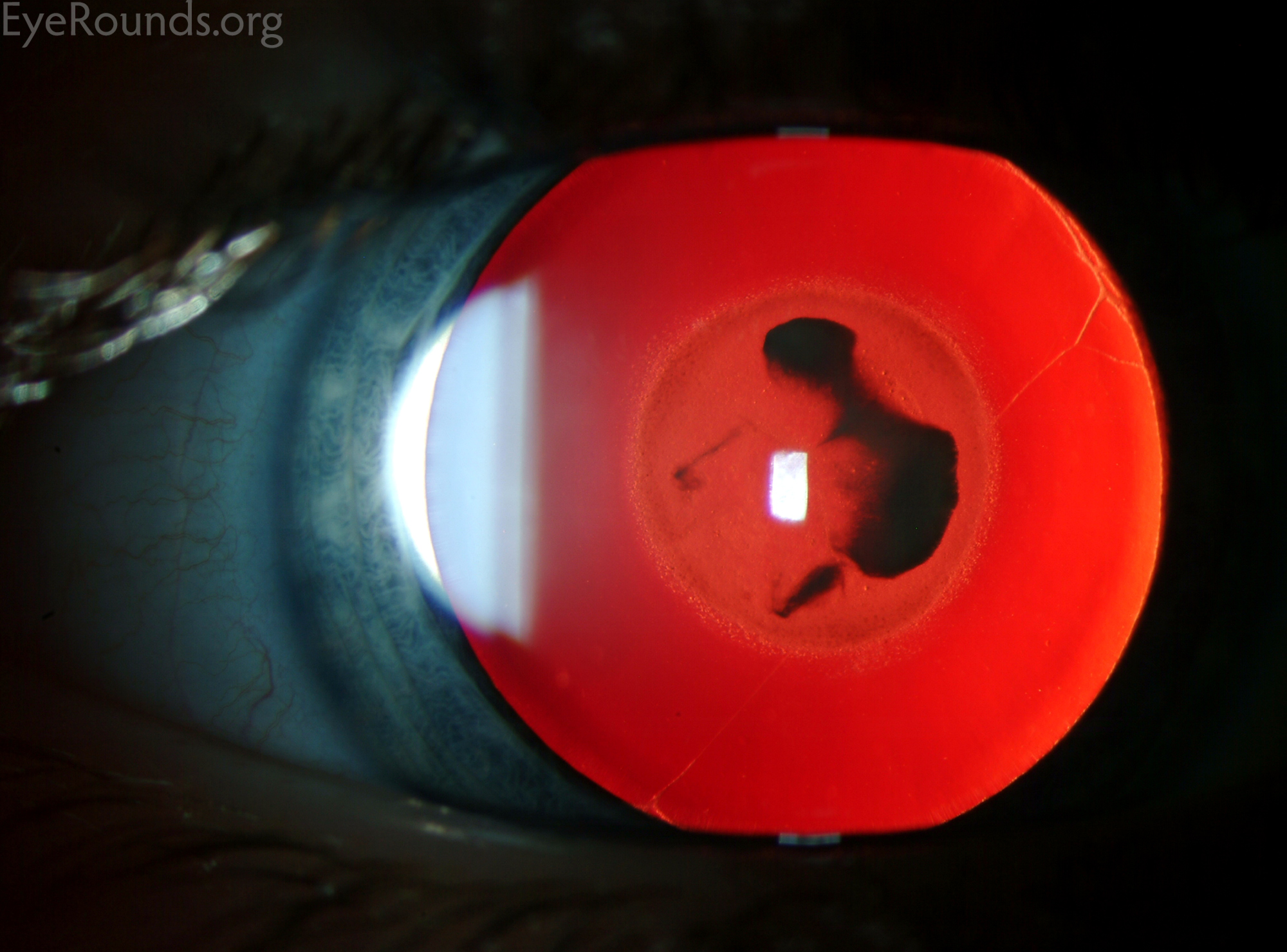 red reflex congential nuclear cataract