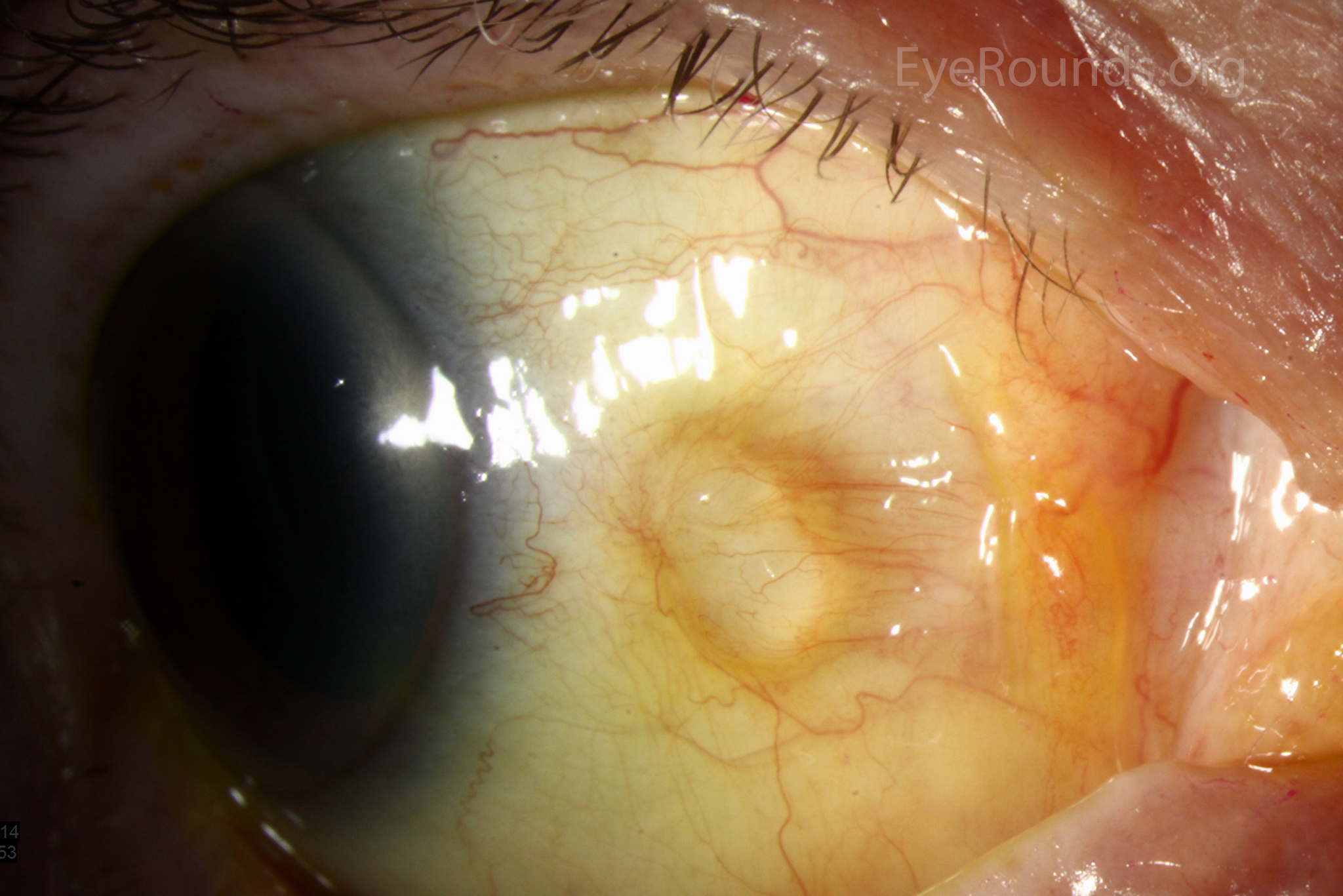 Conjunctival Retention Cyst