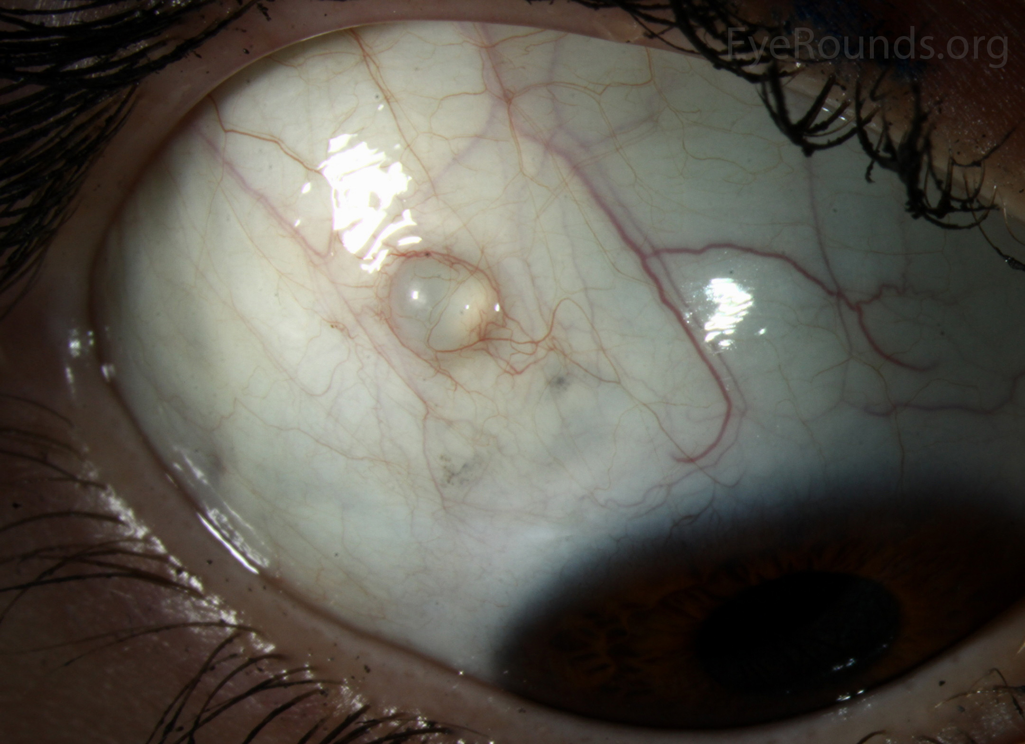 Conjunctival Retention Cyst