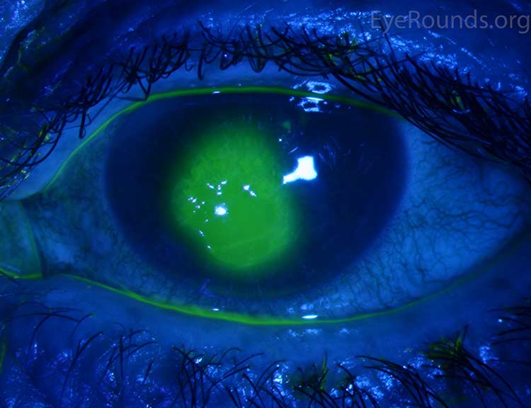 Corneal Abrasion