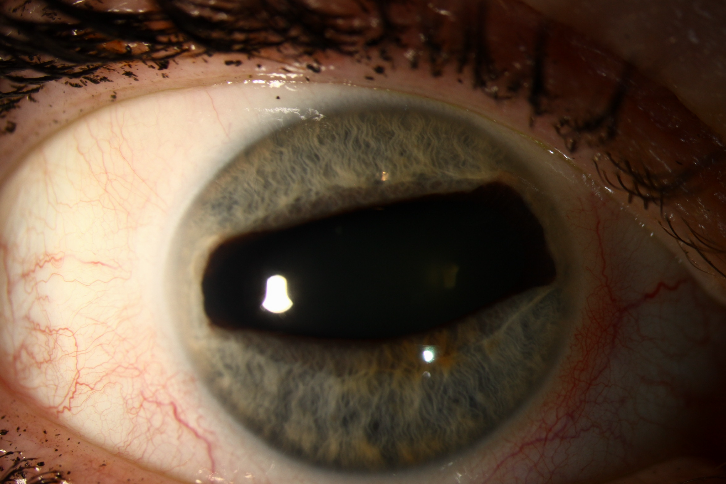 Slit lamp photograph of the right eye showing iris atrophy with an ovoid, horizontal corectopia