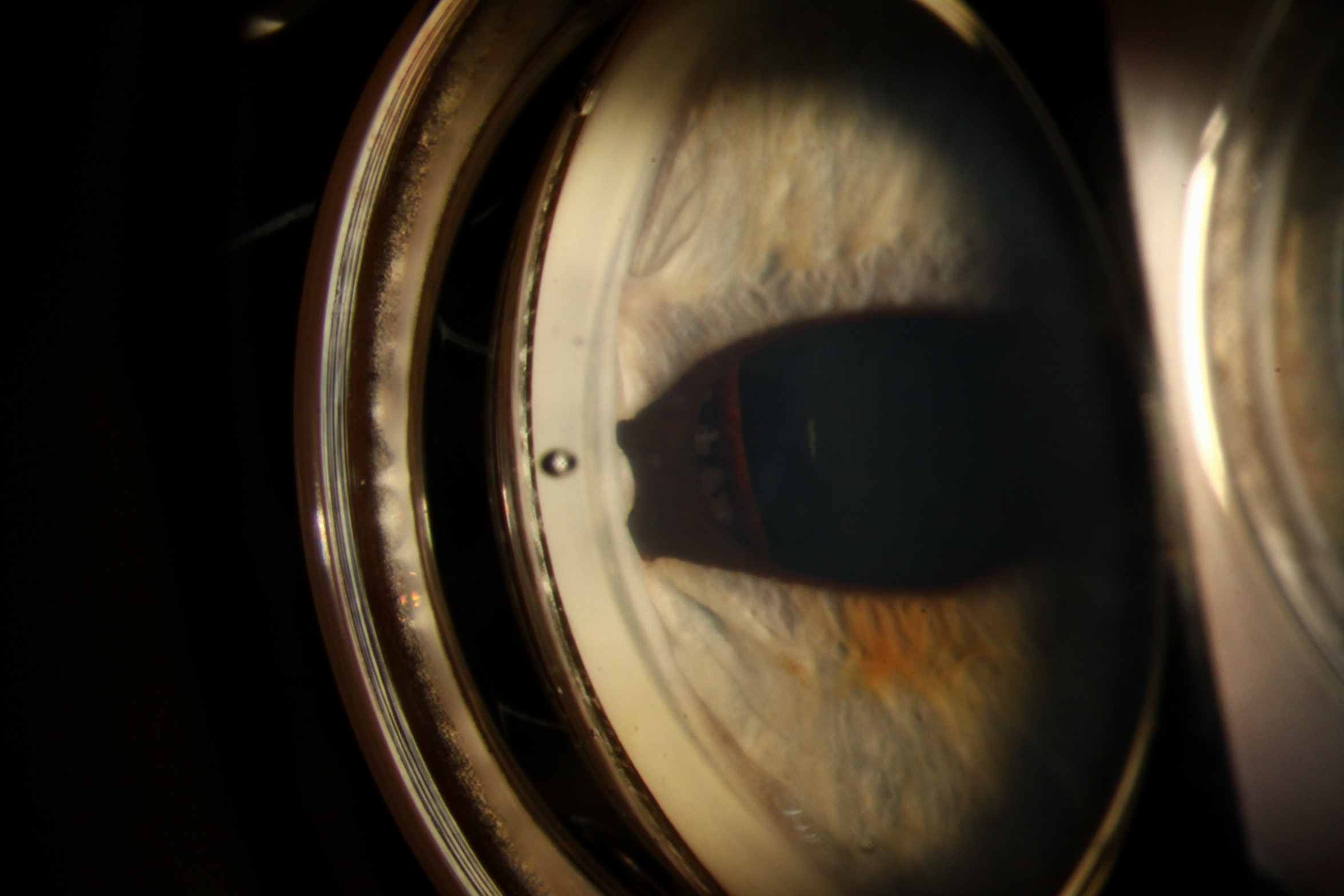  Slit lamp gonioscopy photograph of the right eye showing temporal high peripheral anterior synechiae with ectropion uveae covering the angle