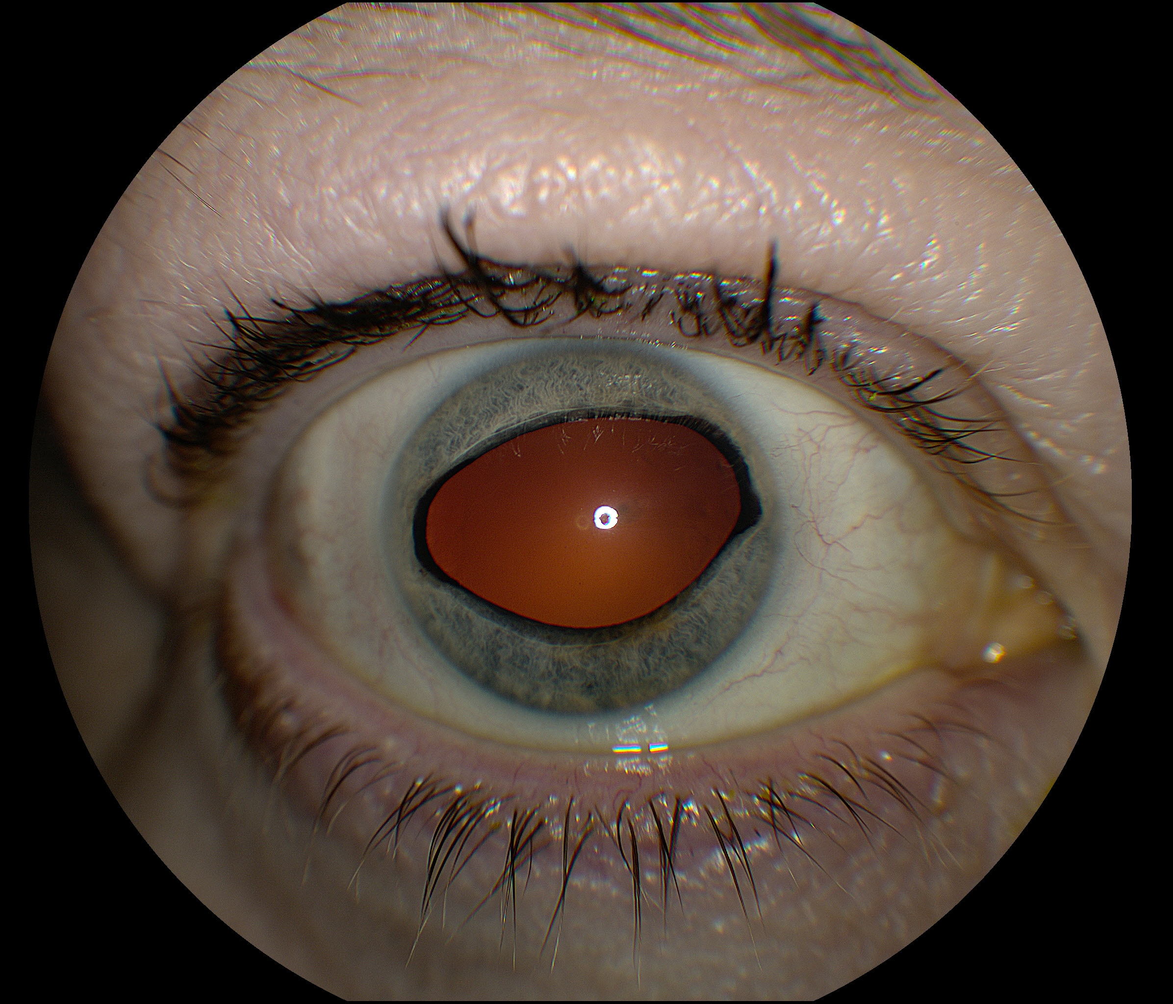 Slit lamp photograph of the right eye demonstrating dilation of the pupil with horizontal dyscoria.