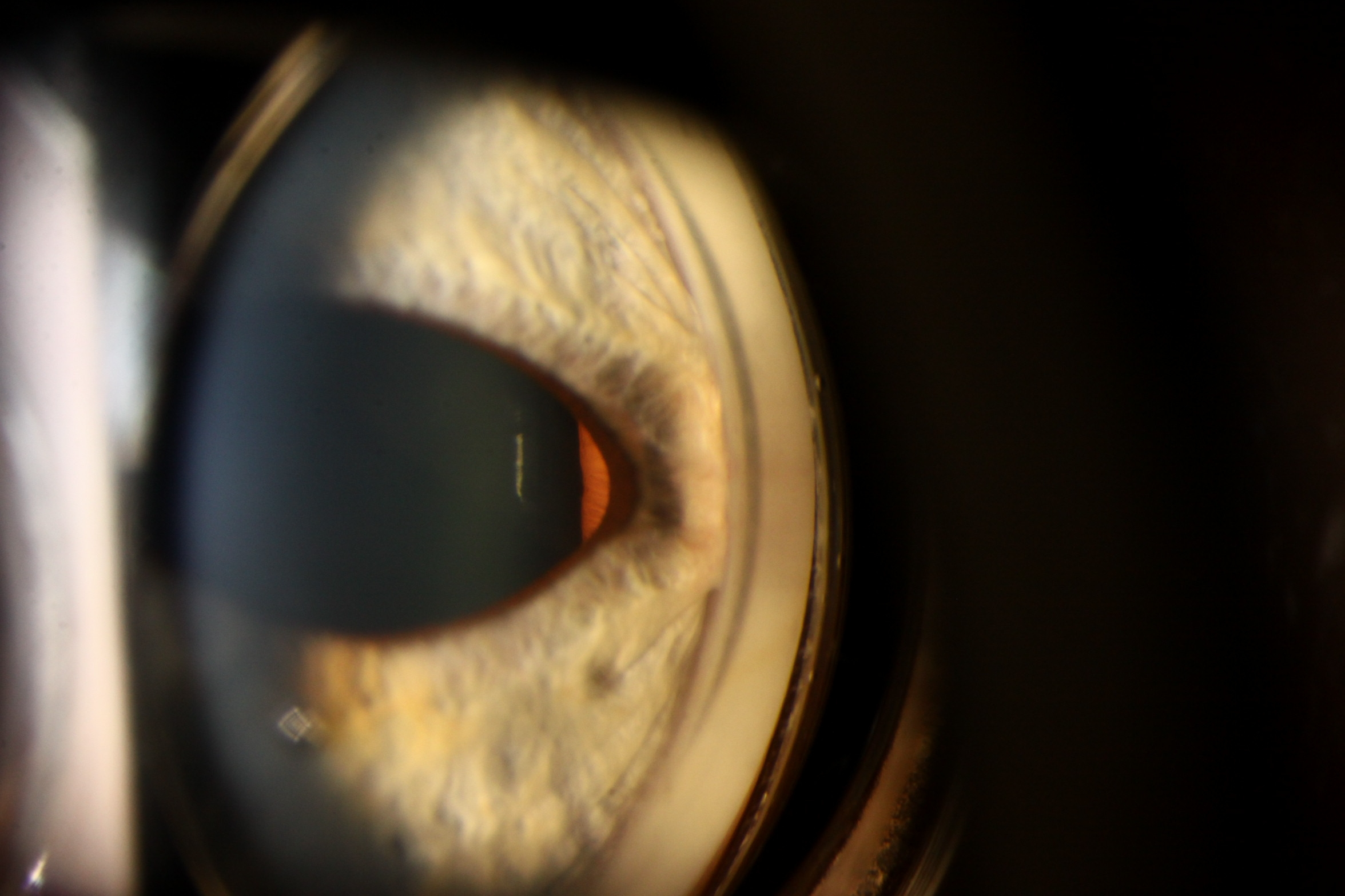 Slit lamp gonioscopy photograph of the right eye showing nasal high peripheral anterior synechiae covering the angle with mild ectropion uveae.