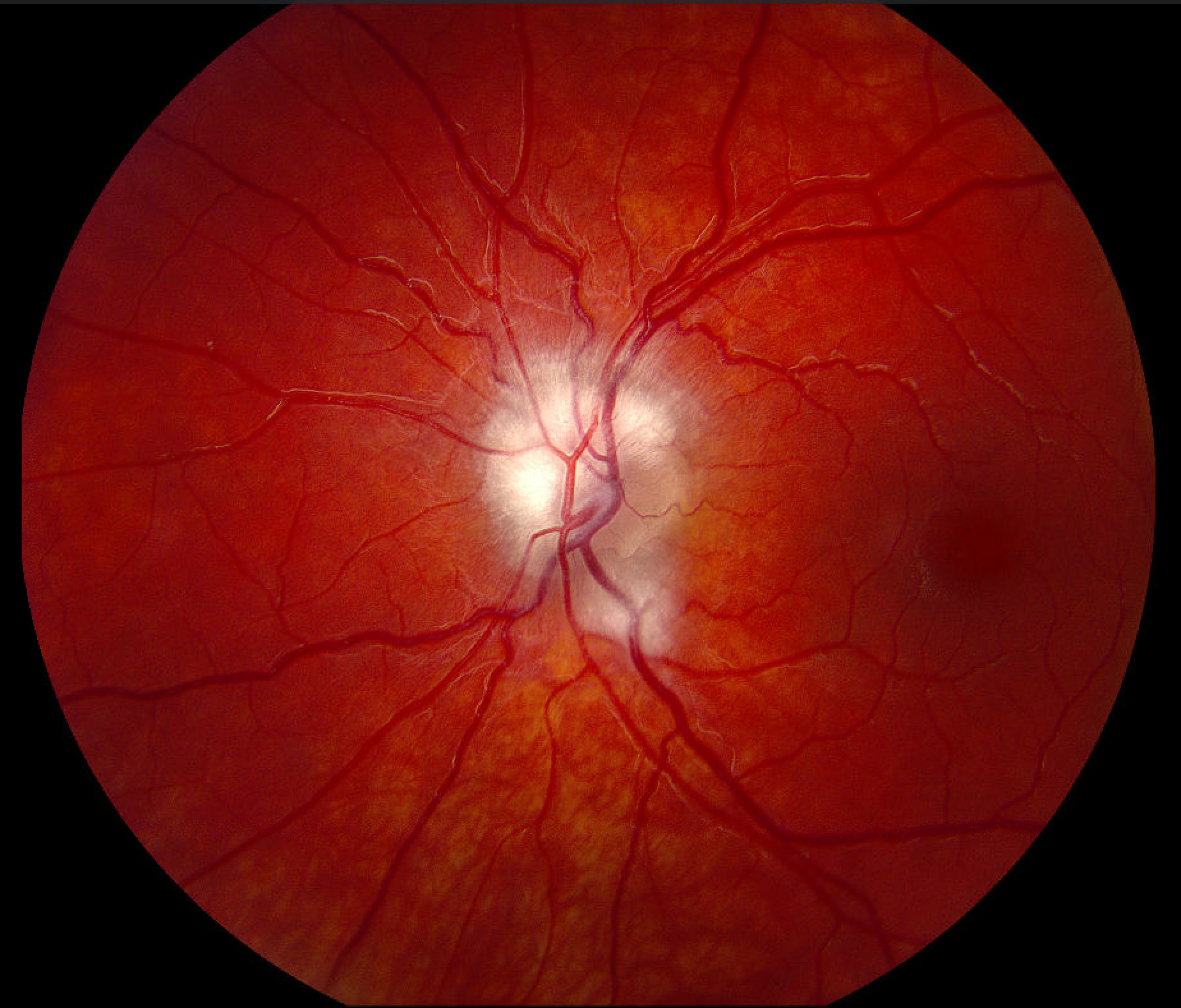 Myelinated nerve fiber layer, left eye