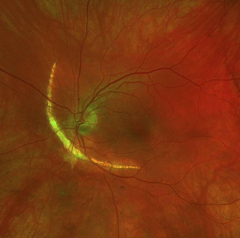  Optos pseudocolor funds photograph of a left eye demonstrating a large, arcuate choroidal rupture just nasal to the optic disc.