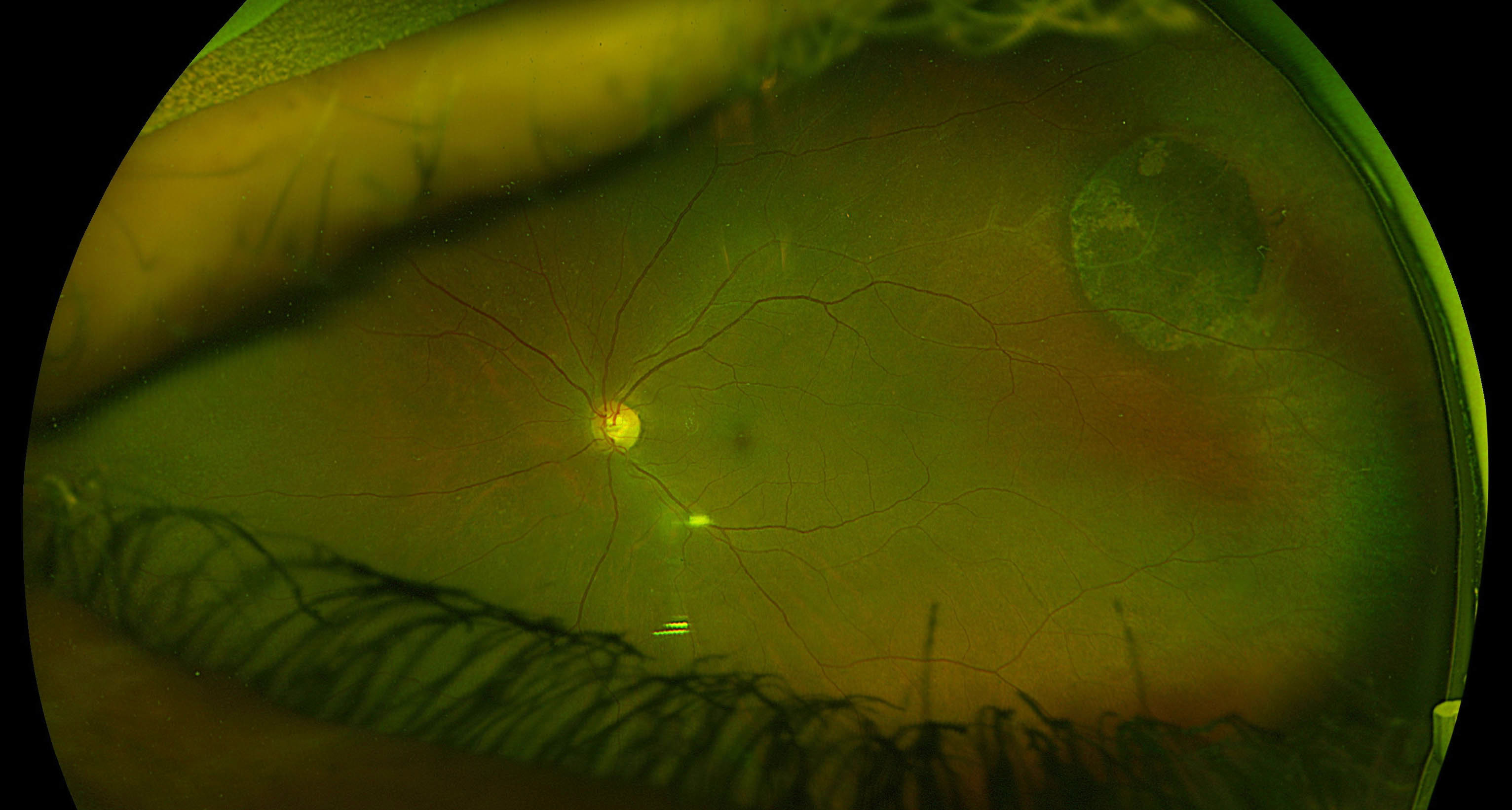 Optos fundus photo of a 57-year-old female featuring congenital hypertrophy of the retinal pigment epithelium (CHRPE) in the superotemporal periphery discovered incidentally on peripheral retinal examination.