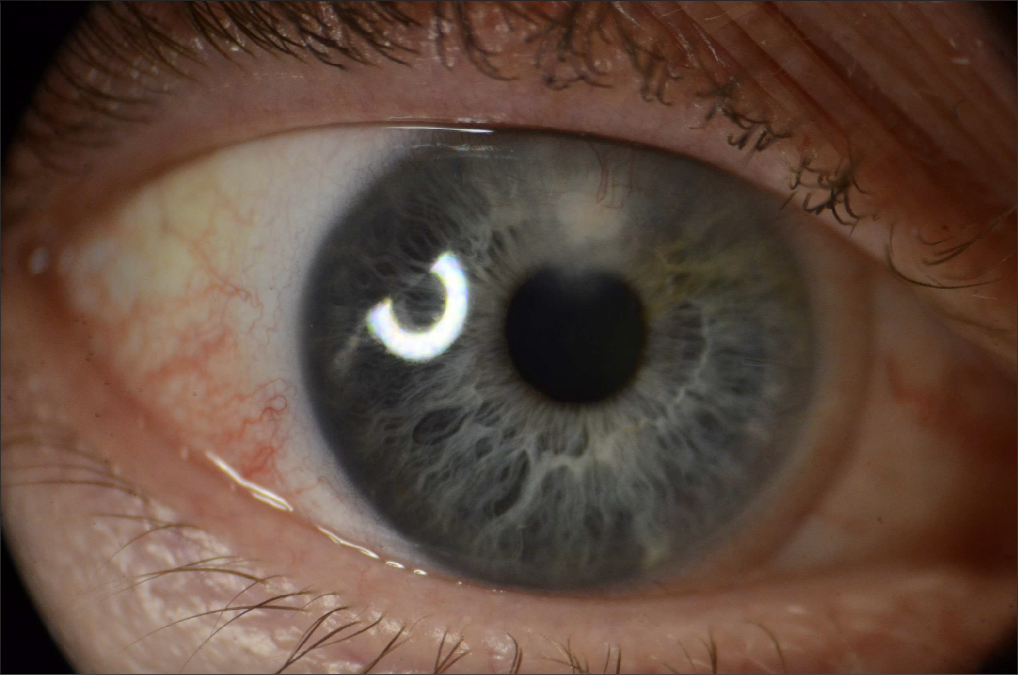 Slit lamp photograph of the right eye in primary gaze showing crystalline infiltrate at the superior hinge of LASIK flap extending into the paracentral cornea with superficial and deep neovascularization.