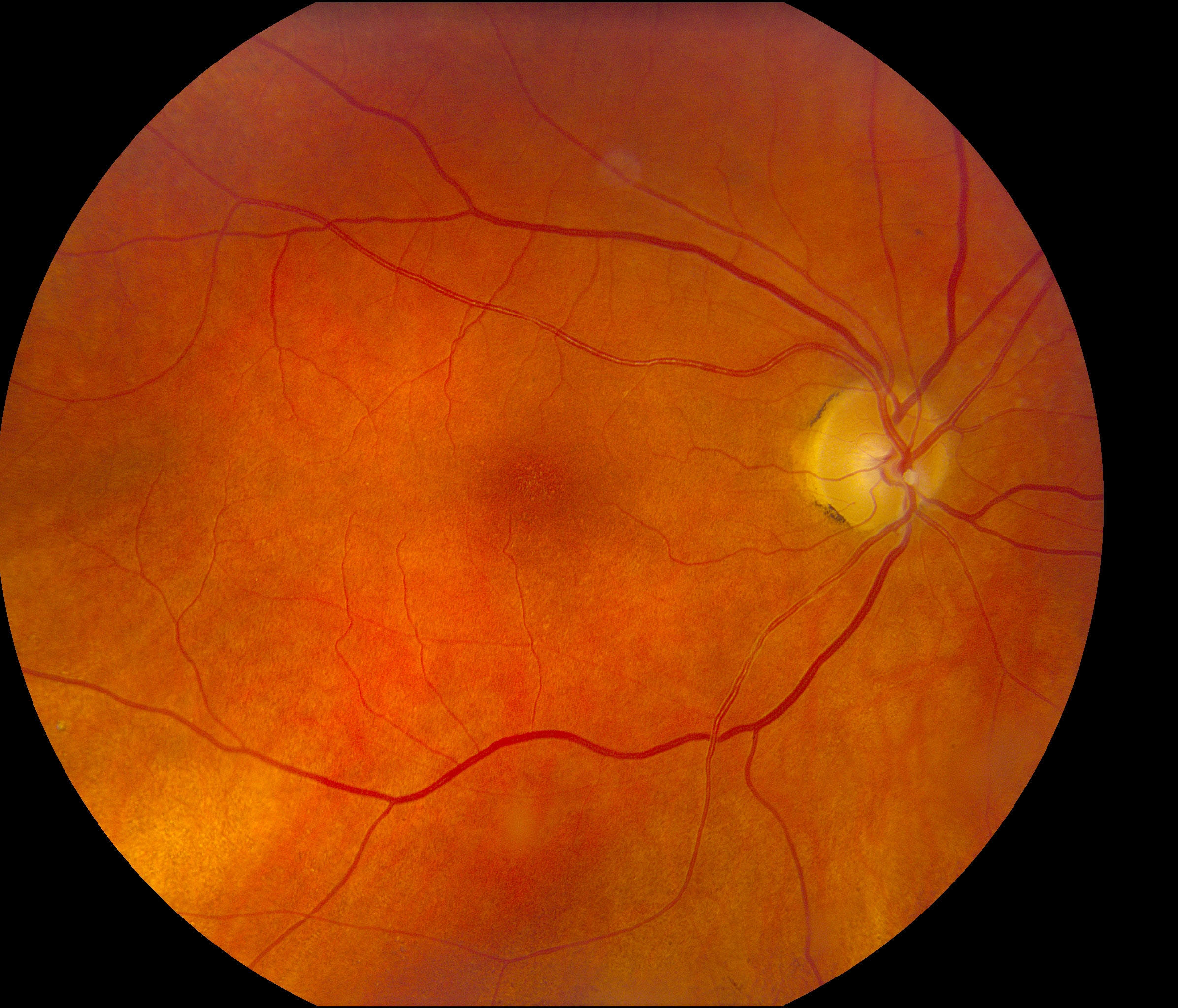 Fundus photo demonstrating a calcium embolus overlying the right optic disc with severely attenuated inferotemporal and inferonasal arcades.