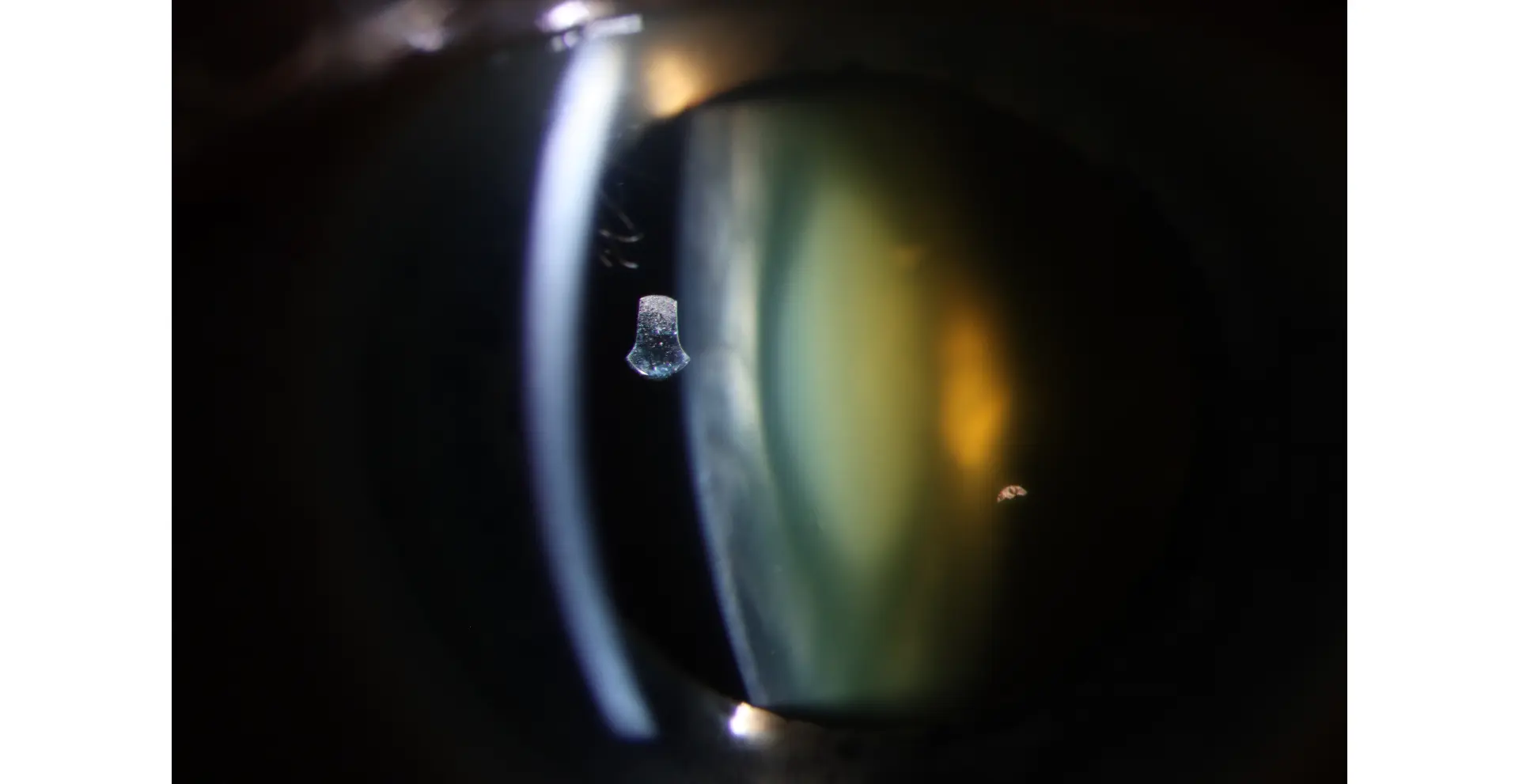 Slit lamp photograph with focus on anterior aspect of lens complex showing a 2+ oil droplet cataract with central nuclear yellow opacity posterior to a clear anterior cortex and anterior nuclear layer.