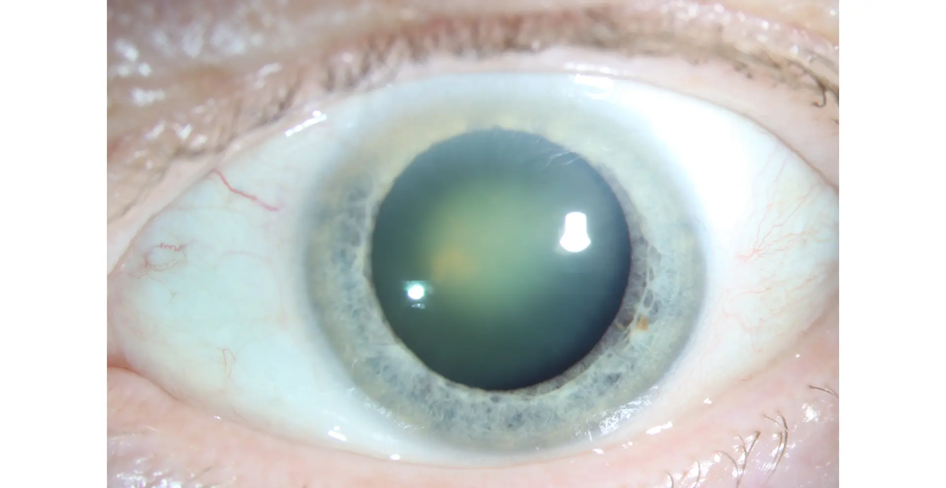 Diffuse illumination slit lamp photograph of an oil droplet cataract showing a central yellowing opacification of the lens with relative peripheral clearing.