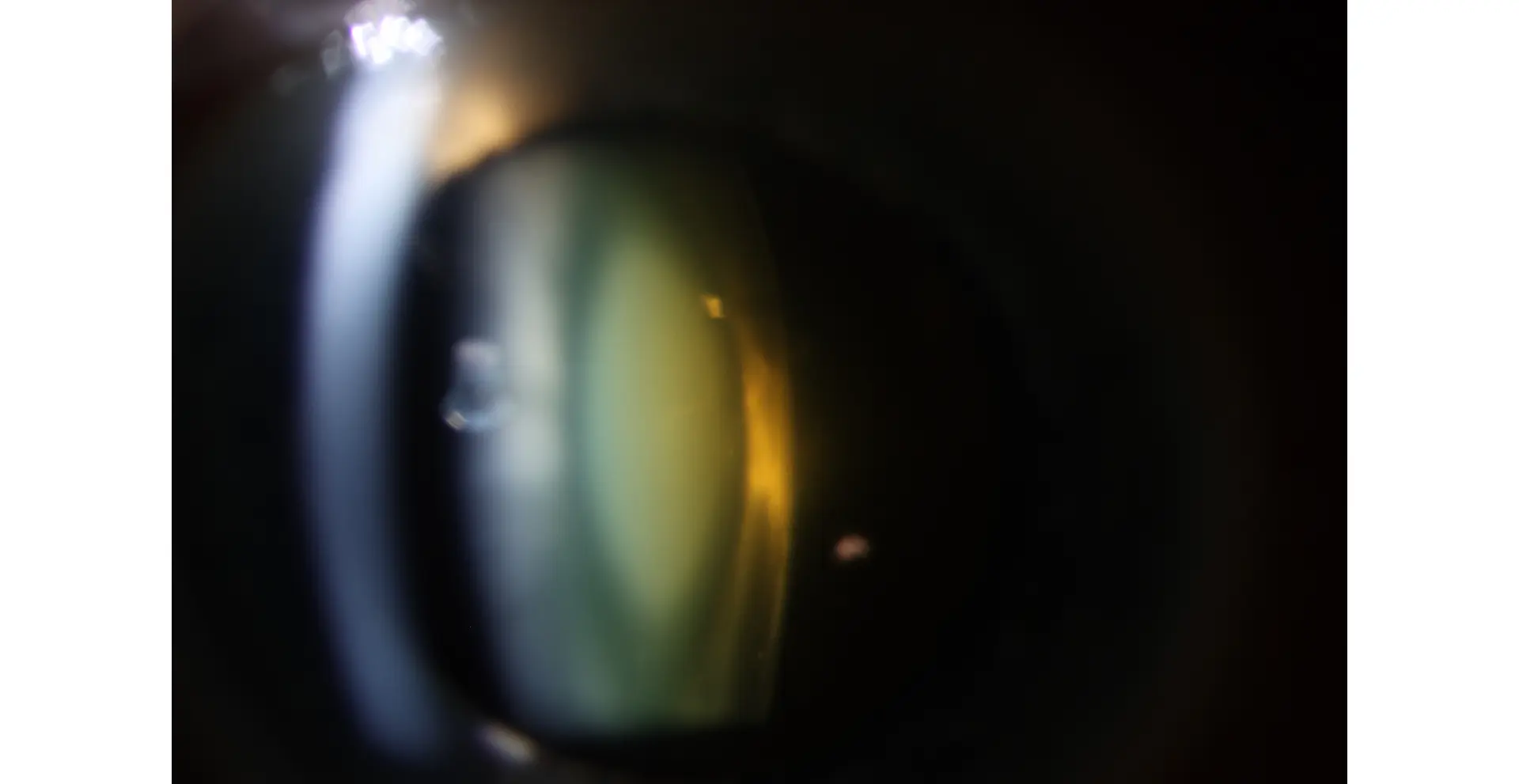 Slit lamp photograph with focus on posterior aspect of lens complex, showing a 2+ oil droplet cataract with central nuclear yellow opacity anterior to a clear posterior nuclear layer and posterior cortex.