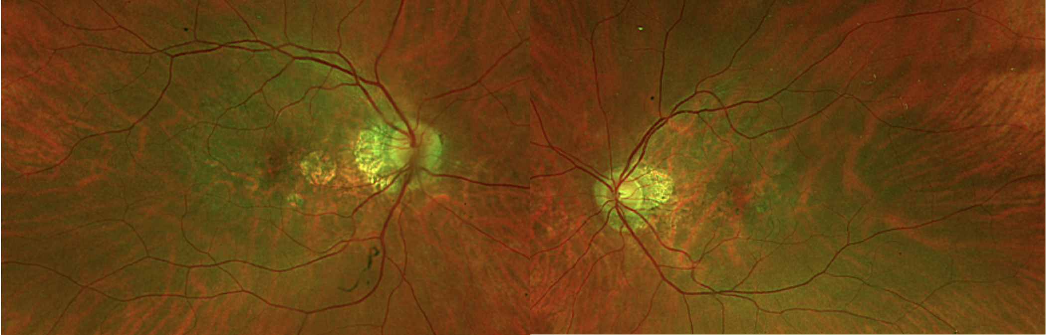 Atlas Entry - Pentosan Polysulfate Maculopathy